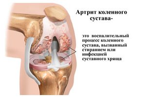 Лечение артрита коленного сустава