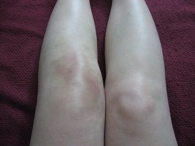 Симптомы и лечение артрита коленного сустава